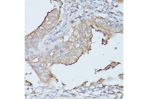 Immunohistochemistry of paraffin-embedded human oophoroma using CE Rabbit pAb (ABIN3015546, ABIN3015547, ABIN3015548 and ABIN6218802) at dilution of 1:100 (40x lens).