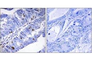 Immunohistochemistry analysis of paraffin-embedded human colon carcinoma, using Nuclear Receptor NR4A1 (Phospho-Ser351) Antibody.