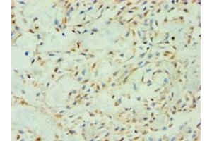 Immunohistochemistry of paraffin-embedded human breast cancer using ABIN7170604 at dilution of 1:100 (Spindlin 2B anticorps  (AA 1-258))