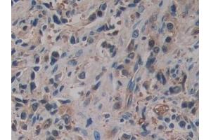 Detection of PTI in Human Prostate cancer Tissue using Polyclonal Antibody to Placental Thrombin Inhibitor (PTI)