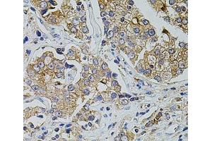 Immunohistochemistry of paraffin-embedded Human prostate cancer using TRPA1 Polyclonal Antibody at dilution of 1:100 (40x lens).