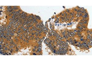 Immunohistochemistry of paraffin-embedded Human colon cancer tissue using GluR2 Polyclonal Antibody at dilution 1:70 (GRIA2 anticorps)