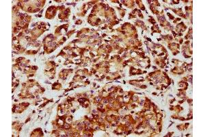 IHC image of ABIN7146684 diluted at 1:800 and staining in paraffin-embedded human pancreatic cancer performed on a Leica BondTM system.