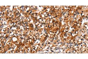 Immunohistochemistry of paraffin-embedded Human prostate cancer tissue using TRIM69 Polyclonal Antibody at dilution 1:40 (TRIM69 anticorps)