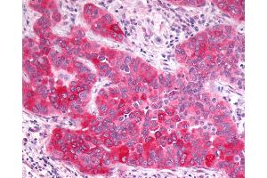 Anti-GPR17 antibody IHC of human Lung, Non-Small Cell Carcinoma. (GPR17 anticorps  (N-Term))
