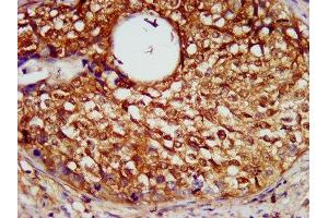 IHC image of ABIN7169341 diluted at 1:600 and staining in paraffin-embedded human cervical cancer performed on a Leica BondTM system.