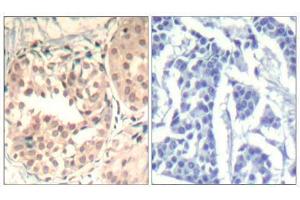 Immunohistochemical analysis of paraffin-embedded human breast carcinoma tissue using CDK6 (phospho-Tyr13) Antibody (E011542). (CDK6 anticorps  (pTyr13))
