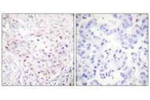 Immunohistochemistry analysis of paraffin-embedded human breast carcinoma tissue, using SENP3 antibody.