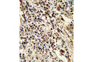 Formalin-fixed and paraffin-embedded human lung carcinoma reacted with PSMA7 Antibody , which was peroxidase-conjugated to the secondary antibody, followed by DAB staining. (PSMA7 anticorps  (AA 100-126))