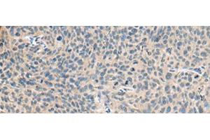 Immunohistochemistry of paraffin-embedded Human cervical cancer tissue using RNASE1 Polyclonal Antibody at dilution of 1:50(x200) (RNASE1 anticorps)