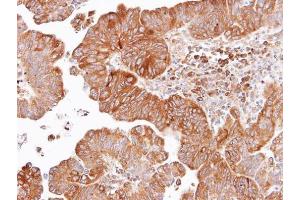 IHC-P Image Immunohistochemical analysis of paraffin-embedded human lung SCC, using Dishevelled 2, antibody at 1:100 dilution. (DVL2 anticorps  (Internal Region))