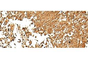 Immunohistochemistry of paraffin-embedded Human lung cancer tissue using TCF7 Polyclonal Antibody at dilution of 1:30(x200)