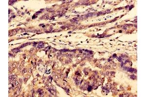 Immunohistochemistry of paraffin-embedded human gastric cancer using ABIN7175699 at dilution of 1:100 (WDFY3 anticorps  (AA 1-100))