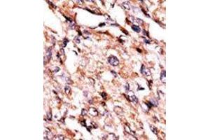 Formalin-fixed and paraffin-embedded human cancer tissue reacted with the primary antibody, which was peroxidase-conjugated to the secondary antibody, followed by AEC staining.