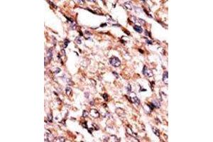 Formalin-fixed and paraffin-embedded human cancer tissue reacted with the primary antibody, which was peroxidase-conjugated to the secondary antibody, followed by AEC staining. (BCKDK anticorps  (Middle Region))