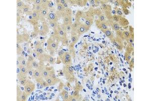 Immunohistochemistry of paraffin-embedded Human liver damage using RHOB Polyclonal Antibody at dilution of 1:100 (40x lens). (RHOB anticorps)