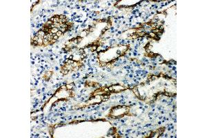 Anti-Aquaporin 4 antibody, IHC(P) IHC(P): Human Lung Cancer Tissue (Aquaporin 4 anticorps  (C-Term))