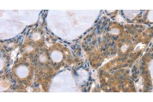 Immunohistochemistry of paraffin-embedded Human thyroid cancer using GNAT3 Polyclonal Antibody at dilution of 1:35 (GNAT3 anticorps)