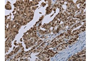 The image on the left is immunohistochemistry of paraffin-embedded Human ovarian cancer tissue using ABIN7191347(MAGEB18 Antibody) at dilution 1/20, on the right is treated with synthetic peptide. (MAGEB18 anticorps)