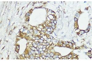 Immunohistochemistry of paraffin-embedded Human lung cancer using SOCS6 Polyclonal Antibody at dilution of 1:100 (40x lens).