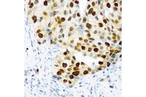 Immunohistochemical analysis of DDX39B staining in human prostate cancer formalin fixed paraffin embedded tissue section. (DDX39B anticorps)