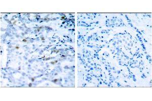 Immunohistochemical analysis of paraffin-embedded breast carcinoma, using CDC2(Phospho-Thr161) Antibody. (CDK1 anticorps  (pThr161))