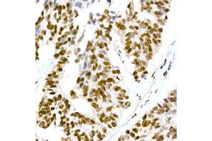 Immunohistochemistry of paraffin-embedded human lung cancer using RBM3 Rabbit mAb (ABIN7270084) at dilution of 1:25 (40x lens). (RBM3 anticorps)