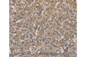 Immunohistochemistry of Human gastric cancer using AGTRAP Polyclonal Antibody at dilution of 1:40