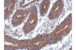 IHC-P Image Immunohistochemical analysis of paraffin-embedded human colon carcinoma, using CCDC37, antibody at 1:500 dilution. (CCDC37 anticorps  (N-Term))