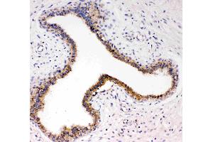 Anti-TrkC antibody, IHC(P): Human Mammary Cancer Tissue