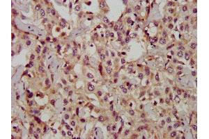 IHC image of  diluted at 1:1200 and staining in paraffin-embedded human liver cancer performed on a Leica BondTM system.