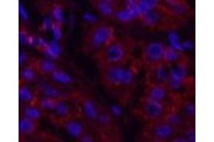 Immunofluorescence analysis of Human stomach cancer tissue using Catenin beta Monoclonal Antibody at dilution of 1:200.