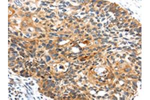 The image on the left is immunohistochemistry of paraffin-embedded Human esophagus cancer tissue using ABIN7127958(CENPM Antibody) at dilution 1/30, on the right is treated with fusion protein.