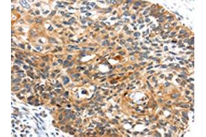 The image on the left is immunohistochemistry of paraffin-embedded Human esophagus cancer tissue using ABIN7127958(CENPM Antibody) at dilution 1/30, on the right is treated with fusion protein. (CENPM anticorps)