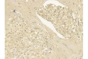 ABIN6259994 and ABIN6276620 at 1/100 staining human prostate carcinoma by IHC-P.