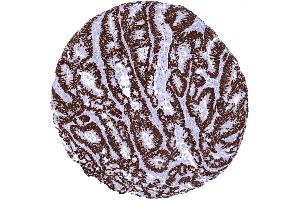 Colon Colorectal adenocarcinoma showing strong SATB2 immunostaining of all tumor cells (Recombinant SATB2 anticorps  (AA 200-300))