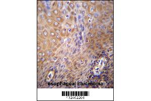 SLC6A14 Antibody immunohistochemistry analysis in formalin fixed and paraffin embedded human esophageal carcinoma followed by peroxidase conjugation of the secondary antibody and DAB staining. (Slc6a14 anticorps  (C-Term))