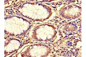 Immunohistochemistry of paraffin-embedded human colon cancer using ABIN7164582 at dilution of 1:100 (C12orf65 anticorps  (AA 36-166))