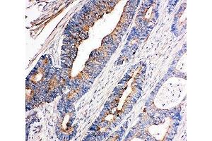 IHC-P: Tec antibody testing of human intestinal cancer tissue