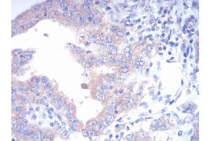 Immunohistochemical analysis of paraffin-embedded endometrial cancer tissues using FGFR3 mouse mAb with DAB staining. (FGFR3 anticorps  (AA 529-694))