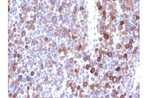 Formalin-fixed, paraffin-embedded human Melanoma stained with Moesin Mouse Monoclonal Antibody (MSN/491). (Moesin anticorps)