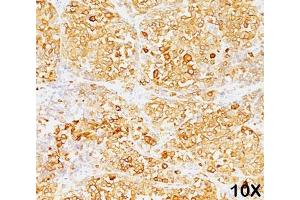 Formalin/paraffin human melanoma stained with MART-1 / Melan-A antibody (M2-9E3). (MLANA anticorps)