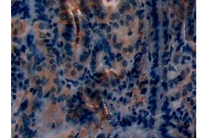 Detection of PKCe in Human Thyroid cancer Tissue using Polyclonal Antibody to Protein Kinase C Epsilon (PKCe)