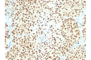 Formalin-fixed, paraffin-embedded human Melanoma stained with SOX10 Monoclonal Antibody (SPM607). (SOX10 anticorps  (AA 115-269))