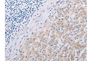 The image on the left is immunohistochemistry of paraffin-embedded Human liver cancer tissue using ABIN7191852(PFN2 Antibody) at dilution 1/30, on the right is treated with synthetic peptide. (PFN2 anticorps)