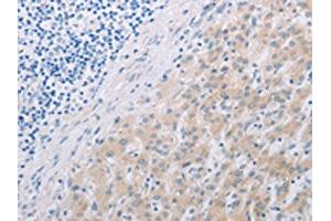 The image on the left is immunohistochemistry of paraffin-embedded Human liver cancer tissue using ABIN7191852(PFN2 Antibody) at dilution 1/30, on the right is treated with synthetic peptide. (PFN2 anticorps)