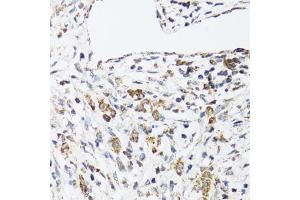 Immunohistochemistry of paraffin-embedded human uterine cancer using DHRS2 antibody (ABIN5973846) at dilution of 1/100 (40x lens). (DHRS2 anticorps)