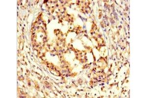 Immunohistochemistry of paraffin-embedded human pancreatic cancer using ABIN7164529 at dilution of 1:100 (GPX8 anticorps  (AA 41-209))