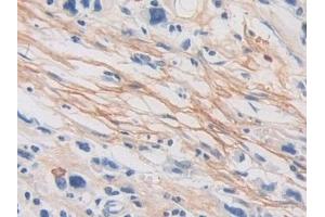 Detection of POSTN in Human Stomach cancer Tissue using Polyclonal Antibody to Periostin (POSTN)