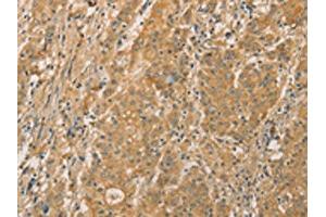 The image on the left is immunohistochemistry of paraffin-embedded Human gastic cancer tissue using ABIN7131118(SNAP91 Antibody) at dilution 1/20, on the right is treated with fusion protein. (SNAP91 anticorps)